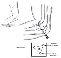 Injection of lateral epicondyle. 