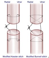 Suture Methods