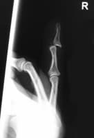 Finger Dislocation