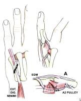 Tendon Transfer Principles And Mechanics: Overview, Technique