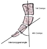 coccyx tumor