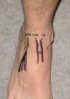 Ankle Arthrocentesis