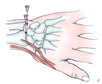 Arthrocentesis, Wrist Arthrocentesis, Wrist