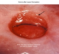 Cervix Conization