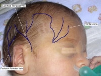 Auricular Vein