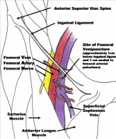 Femoral Artery Cannulation