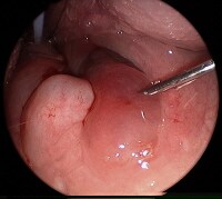 pharyngeal injection