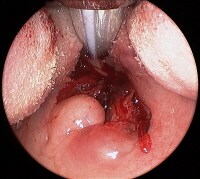 pharyngeal injection
