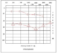 Audiogram Otosclerosis