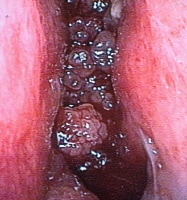 Nasal Mass