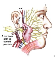 Superficial Parotidectomy