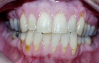 edematous gingiva