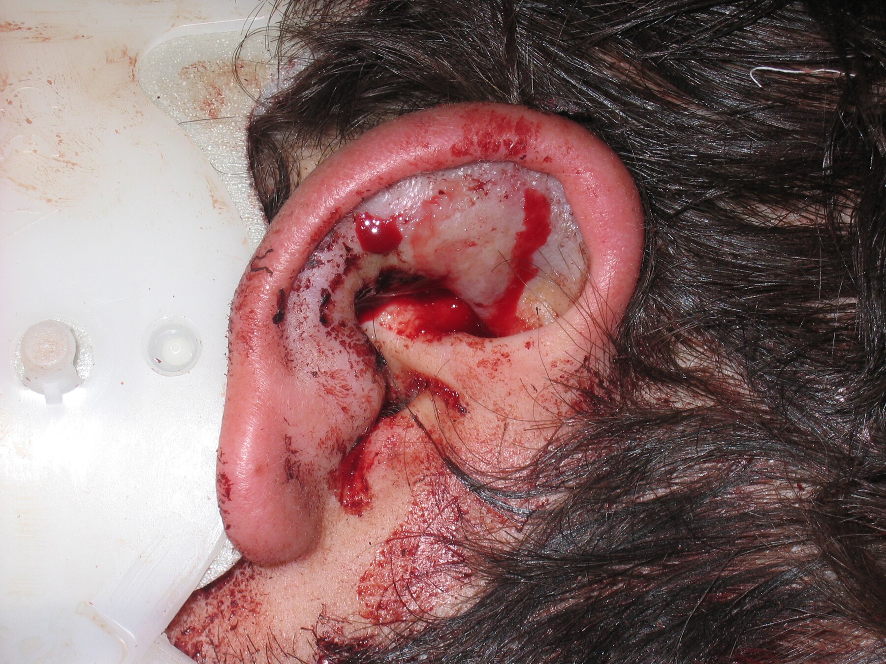 Hematomacrosis Hematomacrosis