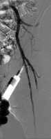 Confirmation angiogram showing appropriate cannula
