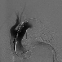 Predeployment angiogram showing the endograft in t