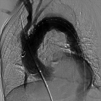 Angiogram performed following endograft deployment