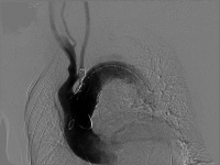 Coil embolization of left subclavian artery to pre