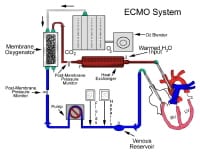 Extracorporeal membrane oxygenation (ECMO) system.