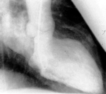 Acute severe mitral regurgitation. Image courtesy...