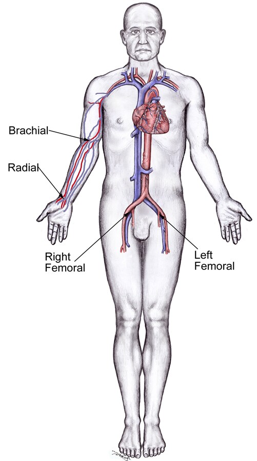 Cardiac catheterization sites.
