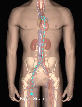 Femoral access. Image courtesy of Olurotimi Bader...