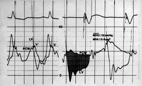 Mitral stenosis tracings. Image courtesy of Oluro...