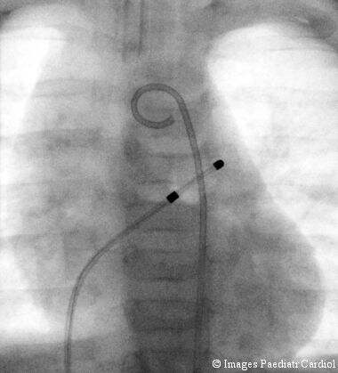Pig tail catheter. Image courtesy of Olurotimi Ba...