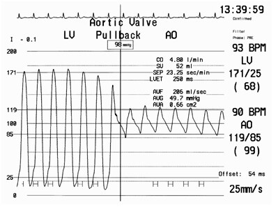 Aortic stenosis tracings. Image courtesy of Oluro...