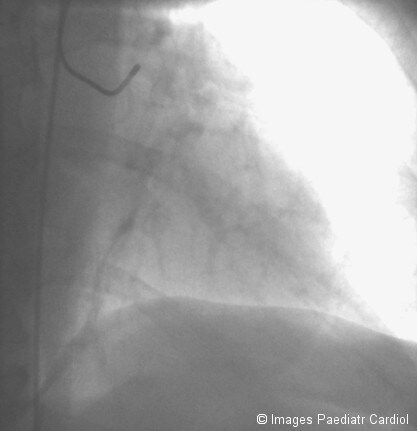 Judkins left catheter in position. Image courtesy...