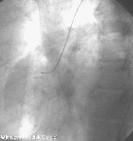 Judkins right catheter in position. Image courtes...