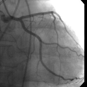 Angiogram showing the left main bifurcating into ...