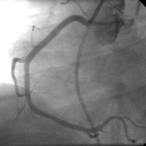 Angiogram showing the right coronary artery. Imag...