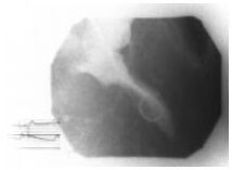 HOCM left ventricular outflow tract. Image courte...