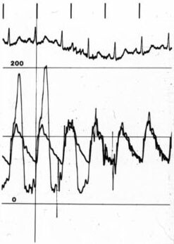 HOCM showing left ventricular outflow tract gradi...