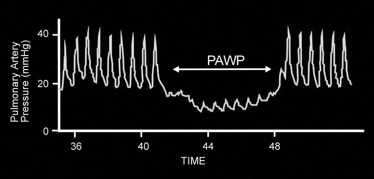 Pulmonary Artery Catheterization 네이버 블로그