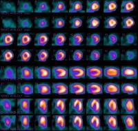 Normal radionuclide uptake (dipyridamole-Cardiolit