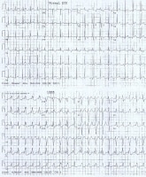 ECGs show a normal sinus rhythm and a sinus rhythm