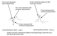 ECG depicts electrophysiologic events of left bund