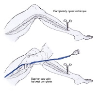 endoscopic vein harvesting