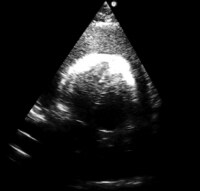 Subxiphoid view of the heart demonstrating a large