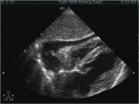 Subxiphoid view of the heart demonstrating a moder