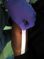 3-mm hole in patient forearm (entrance).