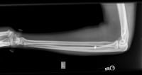 Lateral radiograph depicting foreign body project...