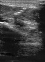 Ultrasound of projectile foreign body fragments i...