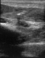 Ultrasound of remaining projectile foreign body f...
