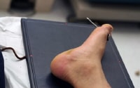 Nail embedded in the foot, propelled by nail gun ...