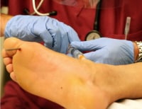Placement of ankle nerve block for traumatic nail...