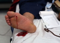 Patient's foot following nail removal. The patien...