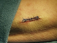 Line of interrupted sutures. 