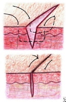 Horizontal mattress suture. 